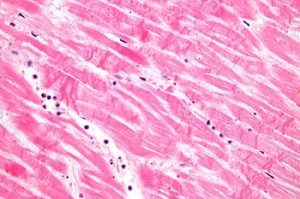MI with contraction bands