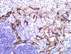 carcinoma