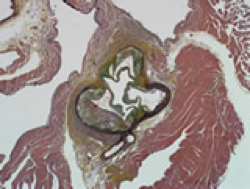 hyperlidemia